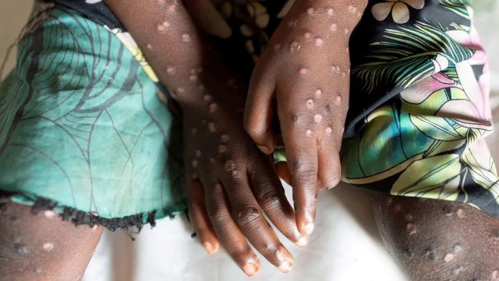 Ugonjwa wa ‘Homa ya Nyani’ watangazwa janga barani Afrika